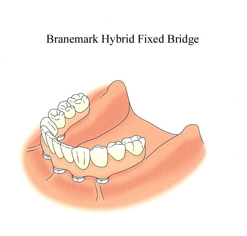 implant-retained-fixed-denture