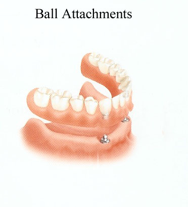 implant-retained-removable-dentures