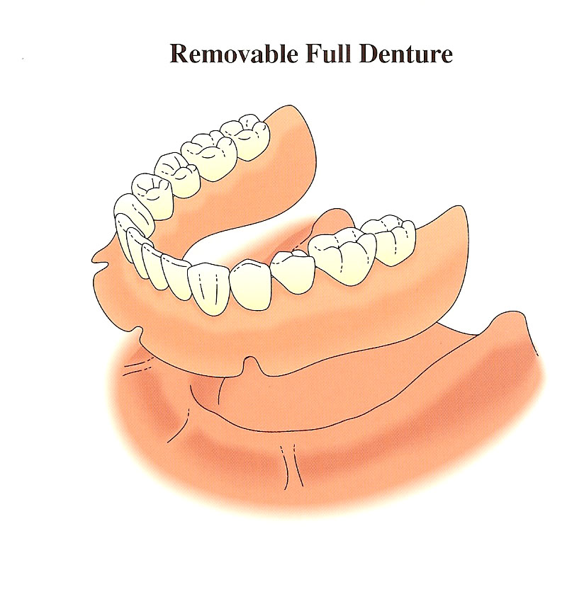 removable-full-denture