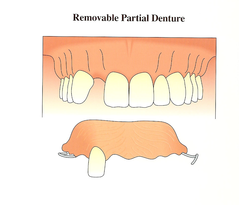 temporary-removable-partial-denture